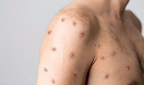 Aparecen más casos de Viruela Símica en Tolima