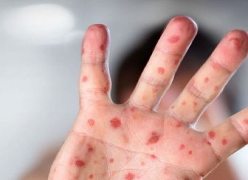 Identificaron nuevos síntomas de la viruela del mono