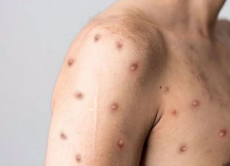 Aparecen más casos de Viruela Símica en Tolima